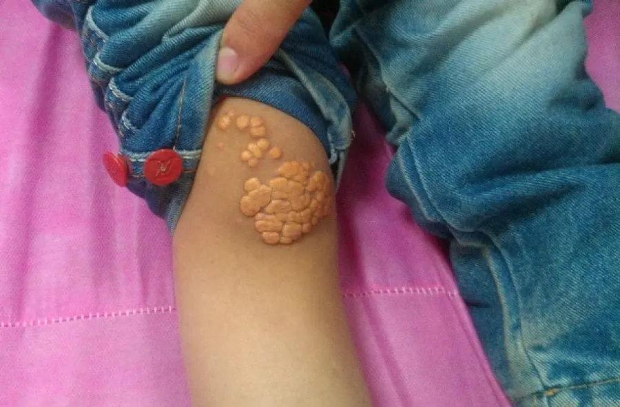 Gli Xantomi, cause e pericoli